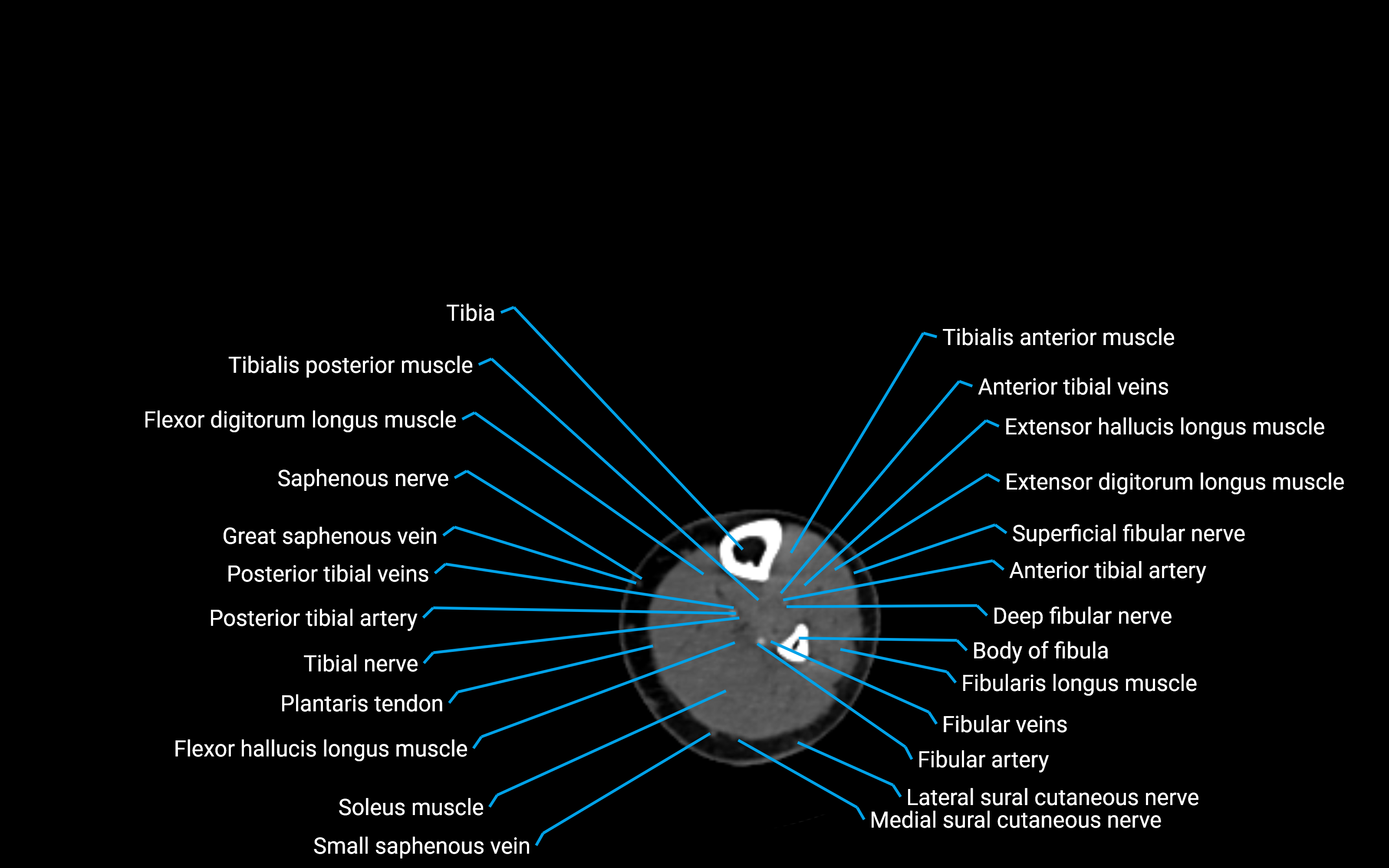 CT Lower leg axial cross sectional anatomy labelled image 124 (2).png